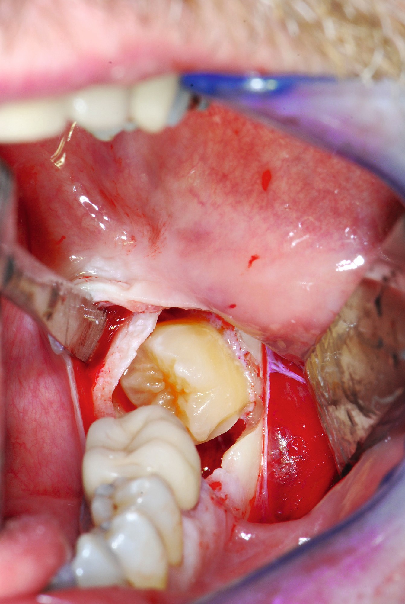 Surgical removal of wisdom teeth - Online DZZ
